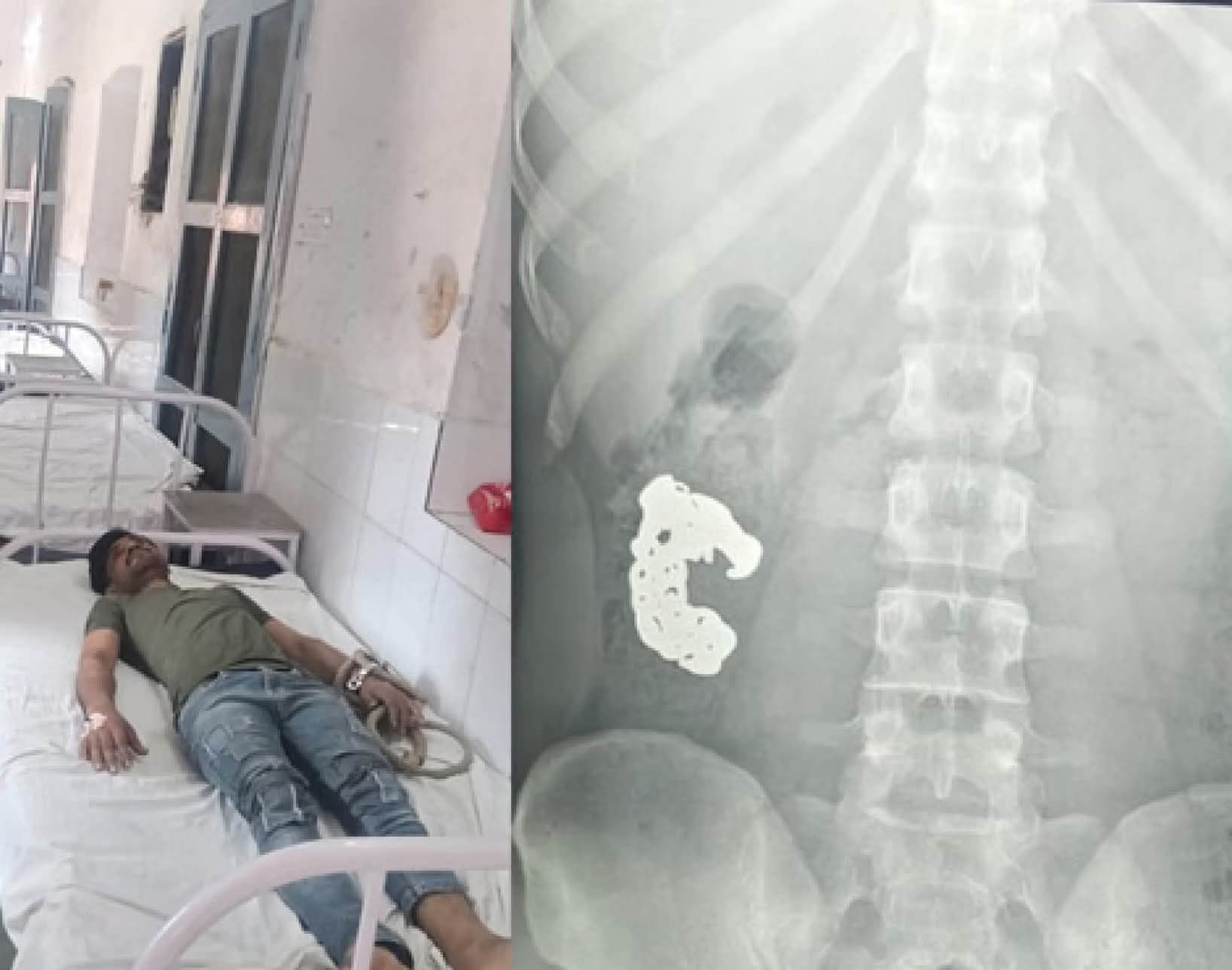 बरेली में चोरी का अनोखा मामला: चांदी का ब्रेसलेट निगल गया चोर, दवा के बाद बरामद